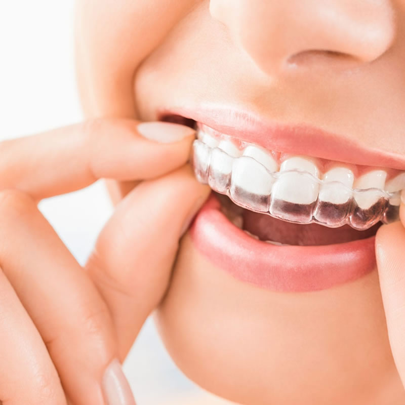 Invisalign – Invisible Braces - Apex Dental Care